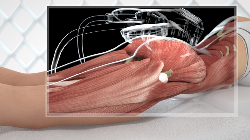 Oblique muscles in girls