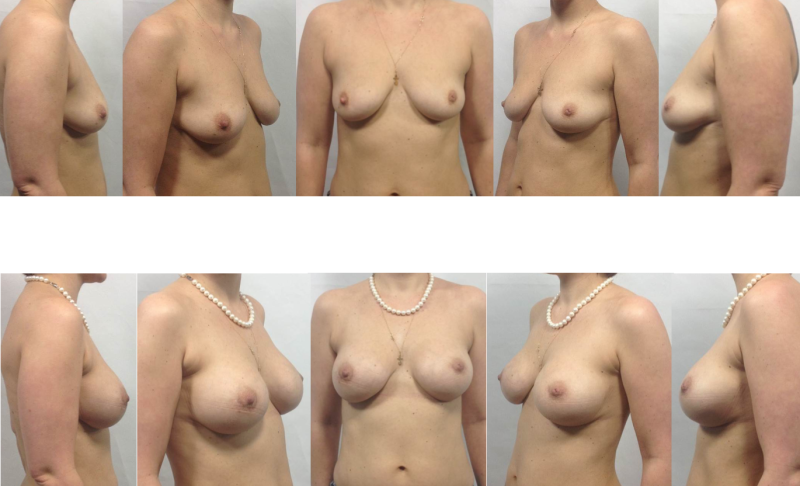 Naked breasts of different shapes