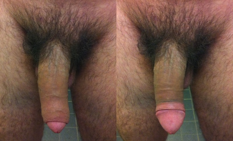 Members of adolescents Uncut Foresskin Docking Small Cut Skin Cock