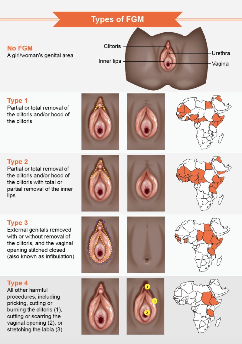 Female circumcision infibulation