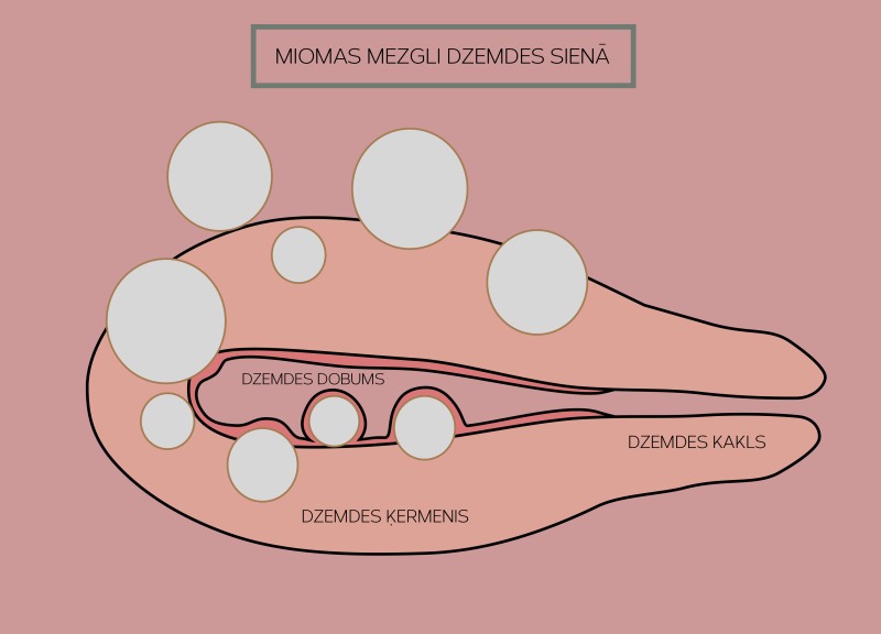 Miomatous nodes and uterine fibroids